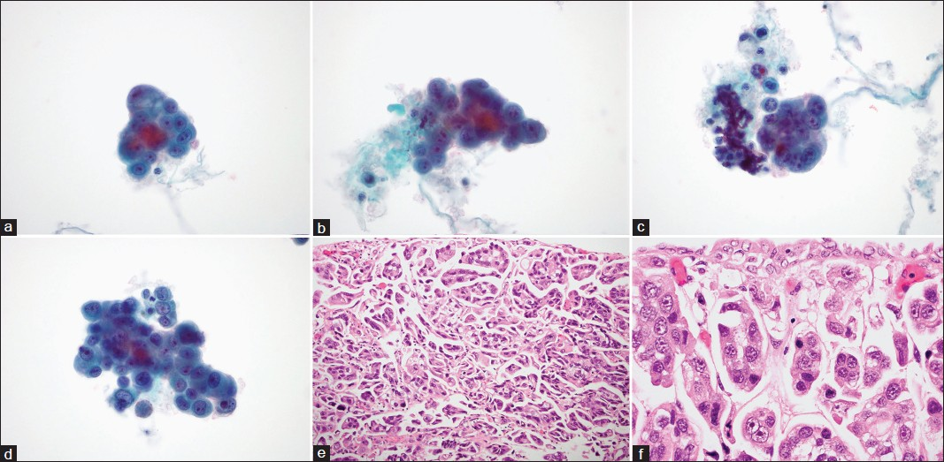 Exfoliative cytomorphology of micropapillary variant of urothelial carcinoma (uPC) (a-d) and corresponding histomorphology (e and f). (a-d) Tightly packed clusters in a three-dimensional arrangement with regular borders with minimal scalloping contain atypical, focally vacuolated, hyperchromatic, nucleolated cells with mostly high and focally intermediate N:C. A few single malignant cells (c and d) are also present (papanicolaou stain on ThinPrep™, ×600). (e and f) Tightly packed clusters of invasive uPC arranged in lacunar spaces. Cells contain markedly atypical nuclei and show focally vacuolated cytoplasm (H and E, ×200 and × 600, respectively)