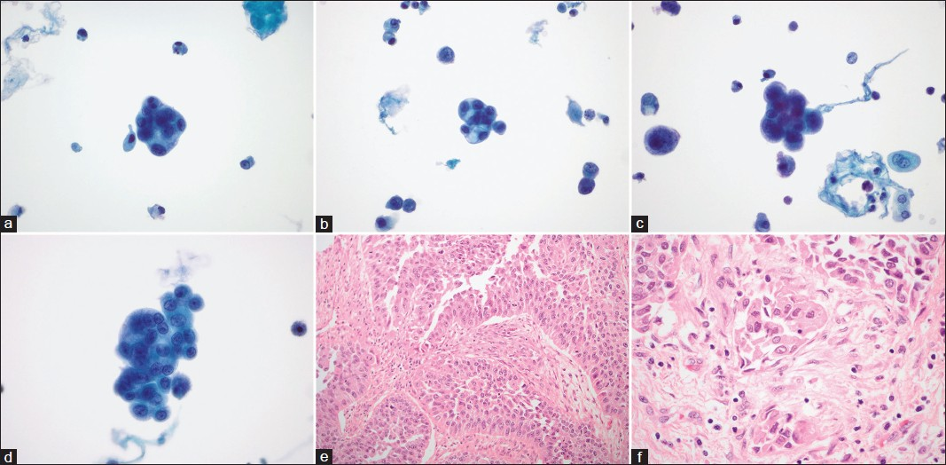 Exfoliative cytomorphology of conventional urothelial carcinoma (CUC) (a-d) and corresponding histomorphology (e and f). (a-d) Tightly packed cell clusters in a three-dimensional arrangement. Borders of the cell clusters vary from regular to scalloped. The cells demonstrate hyperchromatic chromatin, nucleoli, focally vacuolated cytoplasm, and intermediate to high nuclear-to-cytoplasmic ratio. A few preserved single malignant cells are best seen in B and C (papanicolaou stain on ThinPrep™, ×600). (e and f) CUC demonstrating (e) papillary architecture with true fibrovascular cores and (f) invasion (H and E, ×200 and × 600, respectively)