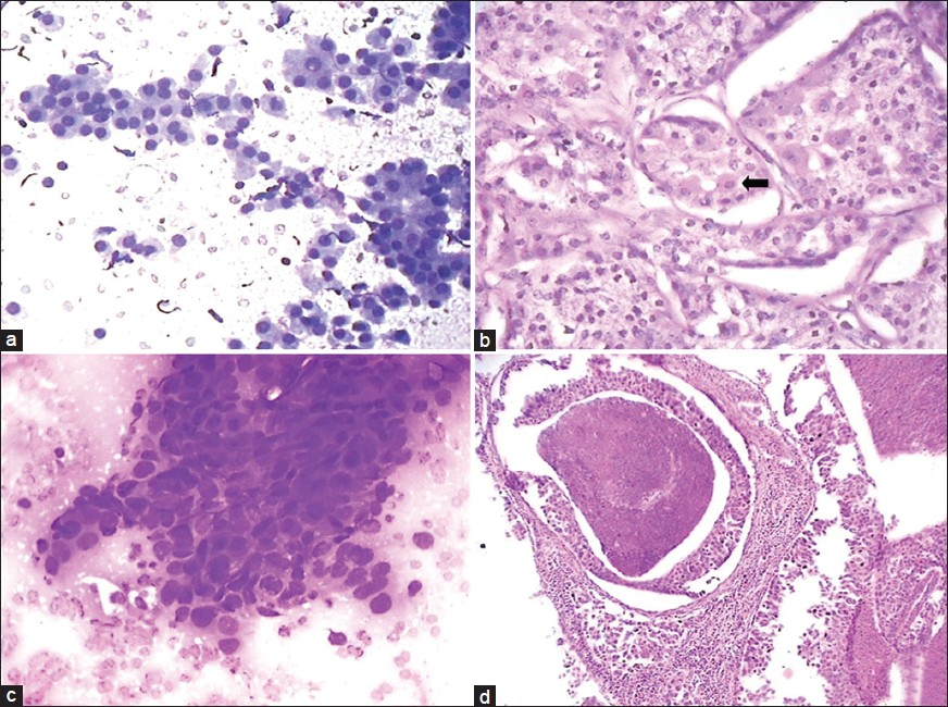 Aspiration smear composed of oncocytic cells with dense granular cytoplasm (a: Giemsa, ×400) diagnosed as oncocytoma. Histology of the same case as (a) showing vacuolated acinar cells along with few oncocytic cells (b: Arrow, H and E, ×400) and final diagnosis of acinic cell carcinoma. A case of squamous cell carcinoma diagnosed as adenocarcinoma due to vacuolated cells and lack of keratinisation (c: Giemsa, ×400). Histology of a case of salivary duct carcinoma showing comedonecrosis (d: H and E, ×100)