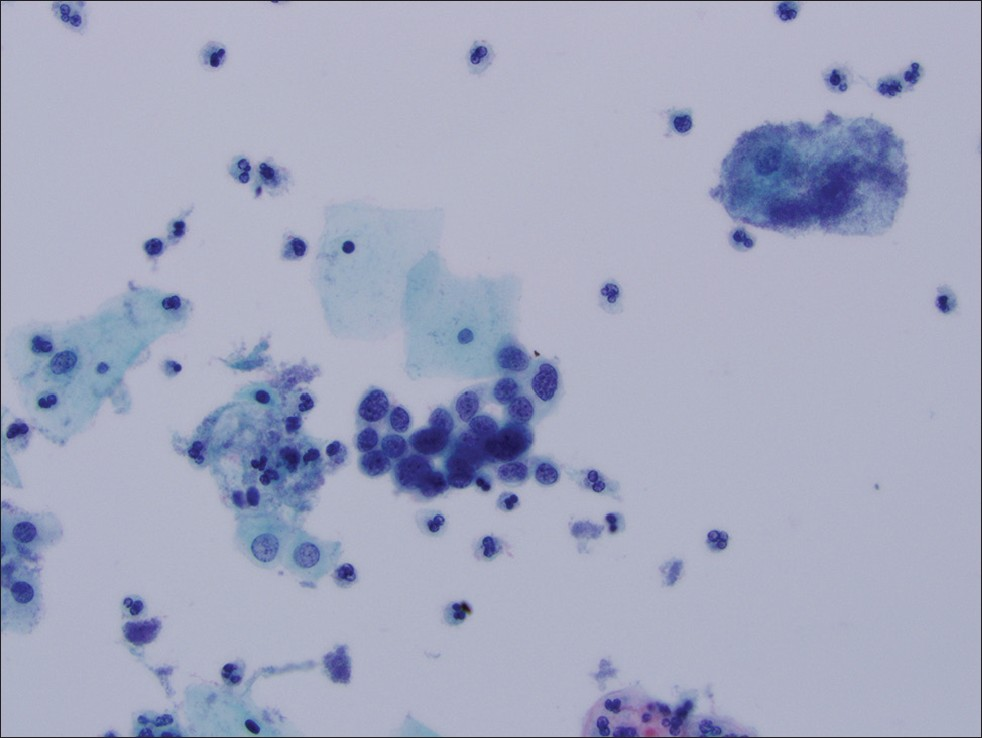 Thin Prep® imaging system screened cervical cytology specimen interpreted as HGSIL. Follow-up histology was cervical intraepithelial neoplasia III