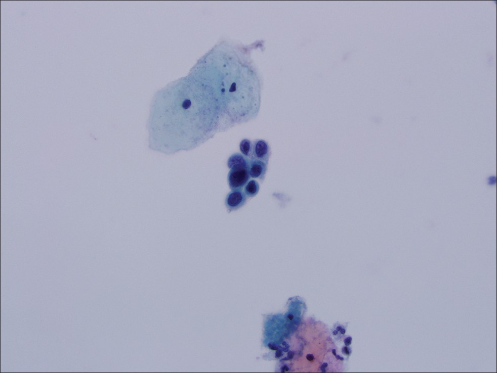 Manually screened cervical cytology specimen interpreted as HGSIL. Follow-up histology was cervical intraepithelial neoplasia III