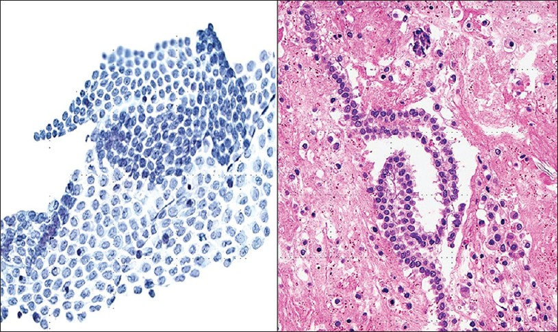 Normal mesothelium in pelvic washings. (Left) This washing shows a large, intact, folded sheet of evenly spaced mesothelium (Pap stain, ×200). (Right) Normal mesothelium is shown arranged as a “string of pearls” in a cell block preparation (H and E, ×200)