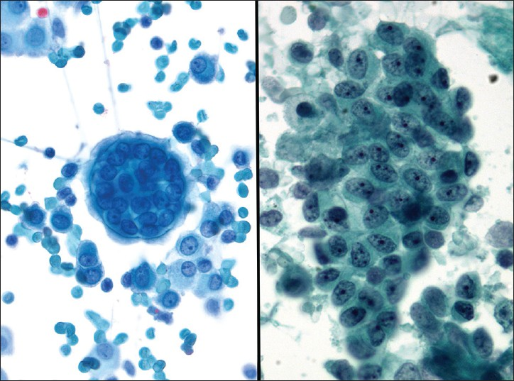 Reactive mesothelium. These clusters contain plump mesothelial cells with small nucleoli (Pap stain, ×600)