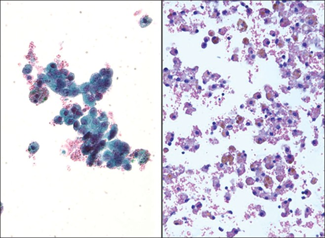 Endometriosis. (Left) This washing contained loose clusters of benign endometrial cells. These cells are of uniform size, small and lack nucleoli. Note also the presence of a few hemosiderin-laden macrophages (Pap stains, ×400). (Right) In this case of endometriosis the washing shows predominantly hemosiderin-laden macrophages associated with old hemolyzed blood (H and E, cell block, ×200)