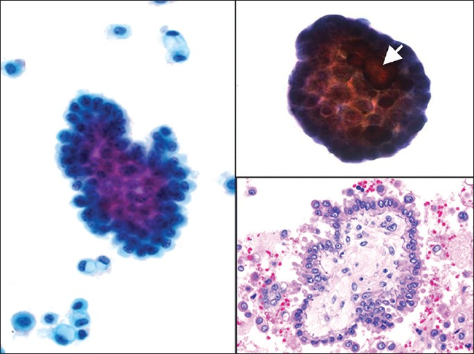 Ovarian serous borderline tumor (SBT). (Left) A papillary group of serous borderline tumor cells with minimal nuclear atypia is shown among many single vacuolated macrophages and reactive mesothelial cells (Pap stain, ×400). (Upper right) A psammoma body is associated with this group of tumor cells, arrow (Pap stain, ×400). (Lower right) Cell block showing a papilla with a stromal core lined by a simple layer of serous tumor cells with mild cytologic atypia (H and E, ×400)