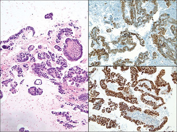 Ovarian high grade serous carcinoma in a pelvic washing. (Left) The cell block shows fragments of serous papillary carcinoma (H and E, ×200). The tumor cells in this case demonstrate positive nuclear immunoreactivity for p53 (Upper right) and PAX8 (Lower right)