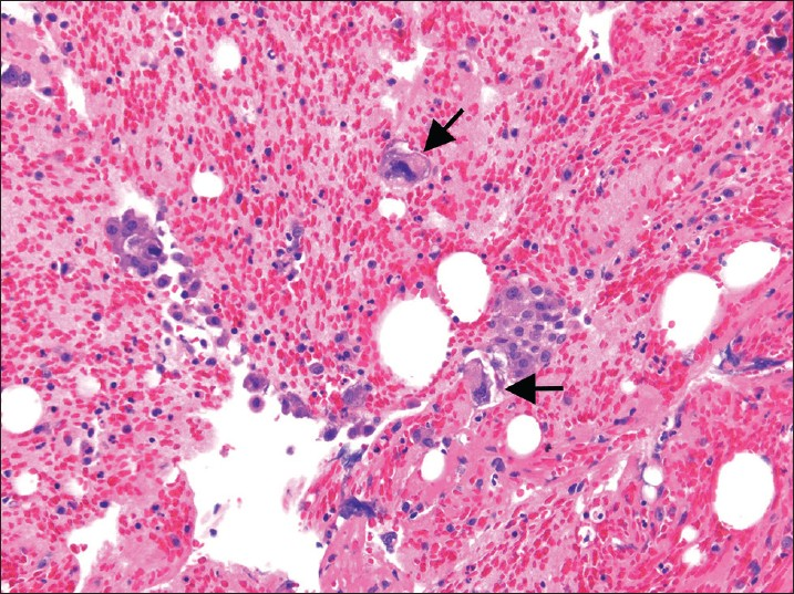 Malignant mixed mullerian tumors in a pelvic washing cell block. This bloody fluid contains a few clusters of carcinoma cells associated with larger, scattered sarcoma tumor cells with markedly pleomorphic and hyperchromatic nuclei (H and E, ×200). Arrow showing markedly pleomorphic cells