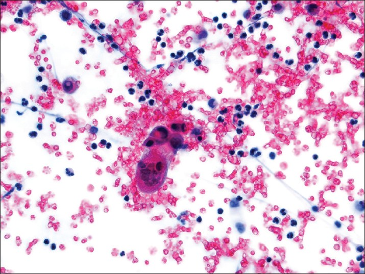 Choricarcinoma in a pelvic washing. A multinucleate syncytiotrophoblast is present in a bloody background (Pap stain, ×400)