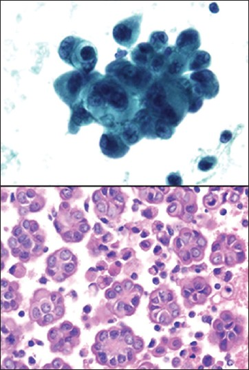 Well differentiated papillary mesothelioma. (Upper left, ThinPrep Pap stain, ×400; Lower Left, cell block H and E, ×400)