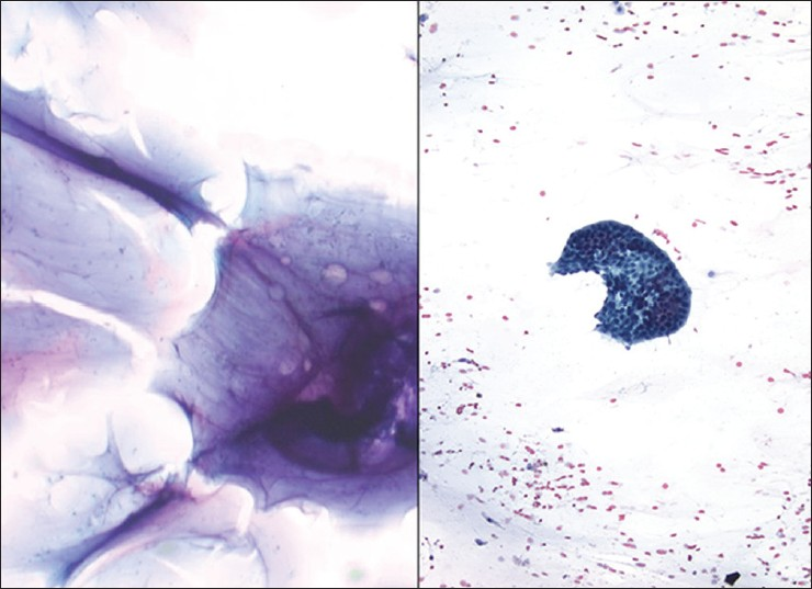 Pseudomyxoma peritonei. (Left) The case shown in the left image presented with only thick copious mucin in the peritoneal cavity (DQ stain, ×200). (Right) The case shown on the right had rare well differentiated groups of adenocarcinoma floating in abundant background mucin (Pap stain, ×200)