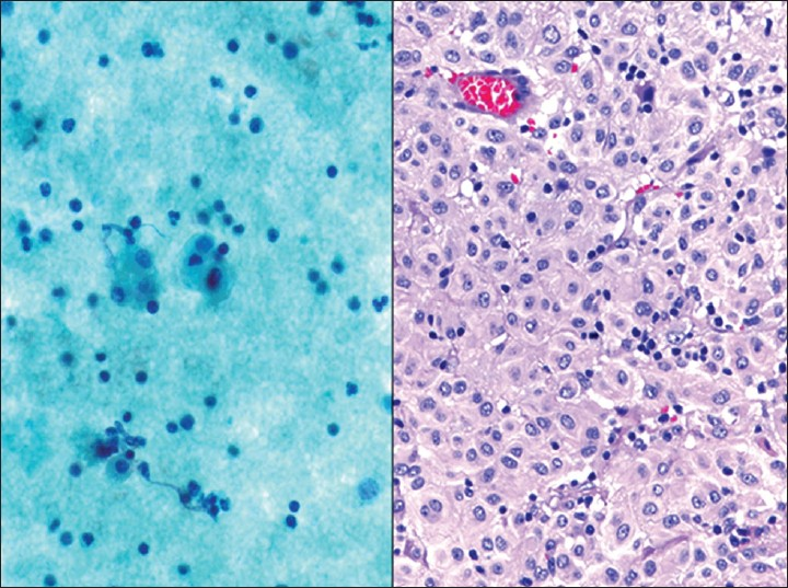 Epithelioid gastrointestinal stromal tumor (GIST). This female patient presented with a large pelvic mass initially thought to be of gynecological origin. (Left) The washing contained bland epithelioid cells with abundant cytoplasm that resembled reactive mesothelial cells (Pap stain, ×400). The tumor cells were immunoreactive for c-kit and the diagnosis of an epithelioid GIST was confirmed on the resection specimen (Right H and E, ×200)