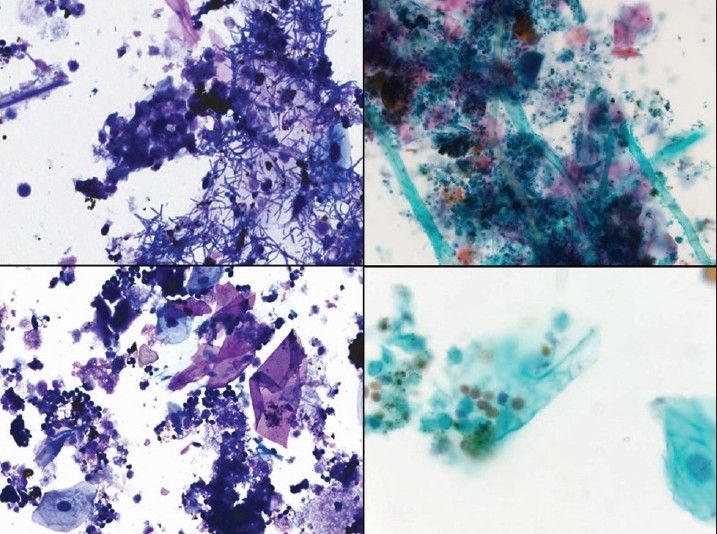 Pleural fluid showing benign squamous cells, debris, bacterial colonies, and fungal colonies consistent with candida. Diff Quik stain, ×400 (left), and Papanicolaou stain, ×200 (right upper) and ×400 (right lower)