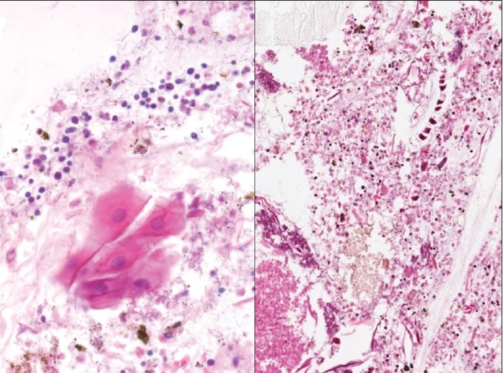 Cell block of pleural fluid showing benign squamous cells, debris, bacterial colonies, and fungal colonies consistent with candida. H and E, stain, ×400, left and ×200, right. The right image shows also vegetable material