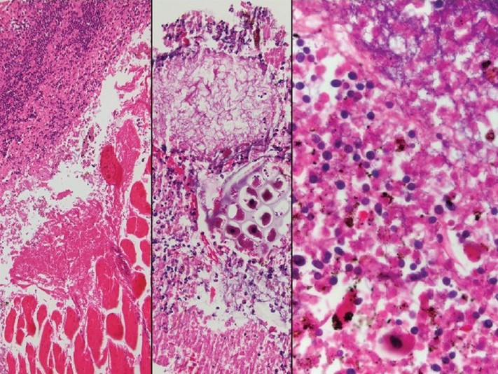 The surgical specimen of esophageal repair and decortications showing inflammatory exudate involving skeletal muscle (left) and containing vegetable materials (middle), and benign squamous cells bacterial and fungal colonies (right). H and E stain, ×100 (left); ×200 (middle), and ×400 (right)