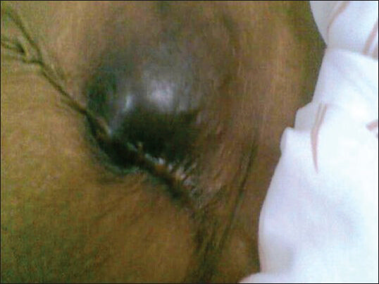 Anterior abdominal wall swelling 3×3 cm with discoloured overlying skin near a scar mark