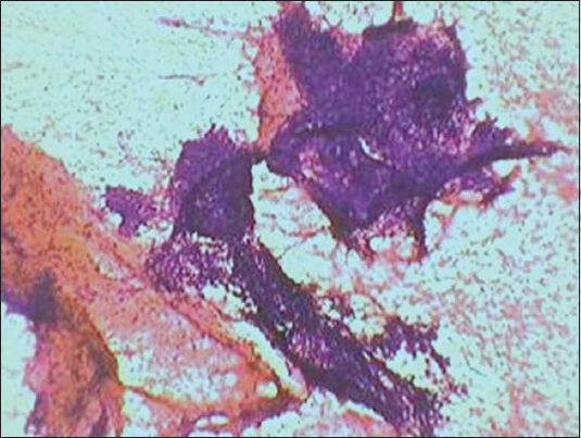 Bimodal population of endometrial glandular and stromal cells seen as compact fragments in haemorrhagic background (PAP ×100)