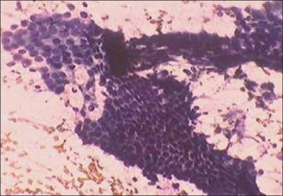 Honeycomb sheets of glandular cells without nuclear atypia (PAP ×400)