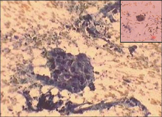 A group of macrophages in the background of blood and debris (PAP ×400) Inset-Hemosiderin laden macrophage