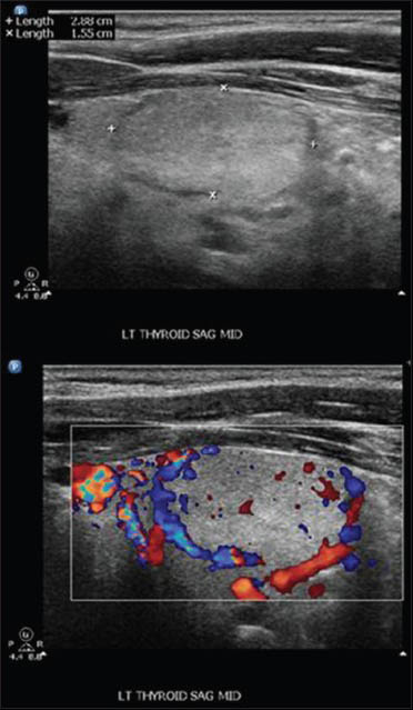 Thyroid ultrasound: Left lobe nodule well circumscribed measuring 2.9 × 1.55 × 1.98 cm without calcifications but with peripheral vascularity