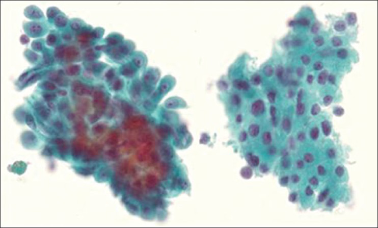 Thyroid FNA ThinPrep: On the left are the mesothelioma cells, which are in three-dimensional groupings compared to the Hürthle cell population on the right, that forms two dimensional sheets. The mesothelioma cells have waxy cytoplasm with multiple nucleoli and more nuclear variation. The Hürthle cell population has abundant granular cytoplasm and generally one nucleolus. Papanicolaou stain ×600