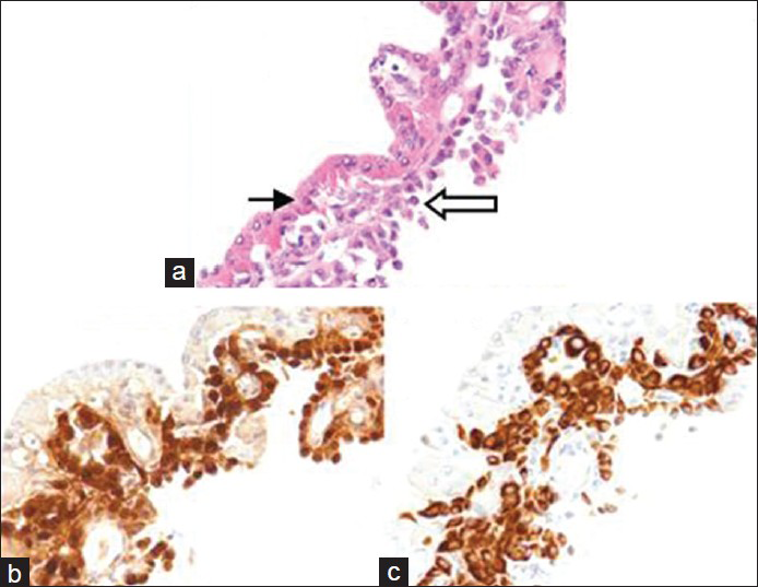 Thyroid FNA cell block: Panel A shows two distinct populations, with Hürthle cells (thin arrow) and mesothelioma cells (open arrow). Panels B and C show calretinin and keratin 5/6 staining, respectively, in the mesothelioma cell population, but not in the Hürthle cell population. (H and E ×400)