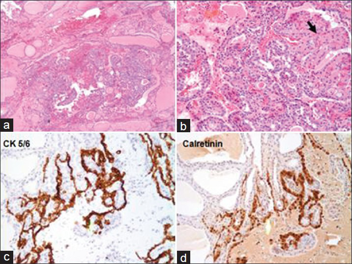 Surgical Resection: Panel A (×40) shows nodular thyroid tissue. Panel B (×40): Two populations of cells seen within the nodule. Hürthle cells (black arrow) shows abundant pink cytoplasm. However, the tissue contains mostly mesothelial cells (white arrow) which are smaller polygonal cells with less cytoplasm. Panel C (×100): Mesothelial cells are positive for keratin 5/6. Panel D (×100): Mesothelial cells are positive for calretinin. Other immunostains (not shown) that were positive in the mesothelial cells include CK7 and HBME1, while TTF-1 and Thyroglobulin were both negative