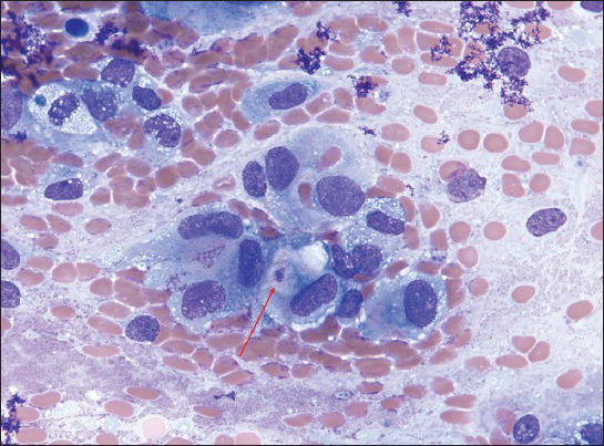 Microcystic variant malignant mesothelioma presenting as a localized