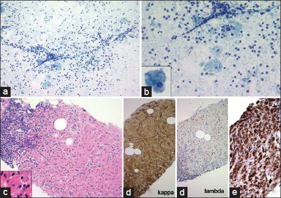 (a and b) Fine-needle aspiration of the mass demonstrate monomorphic lymphocyte population admixed with scattered histiocytes in a clear background. Inset: Histiocyte with refractile cytoplasmic crystals (Diff Quik, ×100 and ×200). (c) Core biopsy showing monomorphic lymphoid aggregate admixed with sheets of histiocytes (H and E, ×100). (d) Immunohistochemistry stains on the core biopsy showing kappa light chain restriction in the lymphocytes as well as in cytoplasmic crystals within histiocytes (kappa and lambda light chain, ×100). (e) CD68 stain performed on the core biopsy highlights CD68+ histiocytes (CD68, ×100)