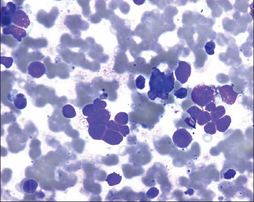 Cytology smear from small cell carcinoma of lung primary, metastatic into mediastinal lymph (diff quick stain, original magnification ×500)