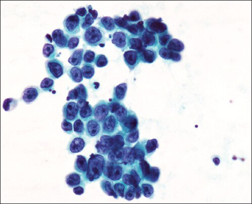 Cytology smear from mediastinal lymph node reveals metastatic Adenocarcinoma of gastric origin (Papanicolau stain, original magnification ×500)