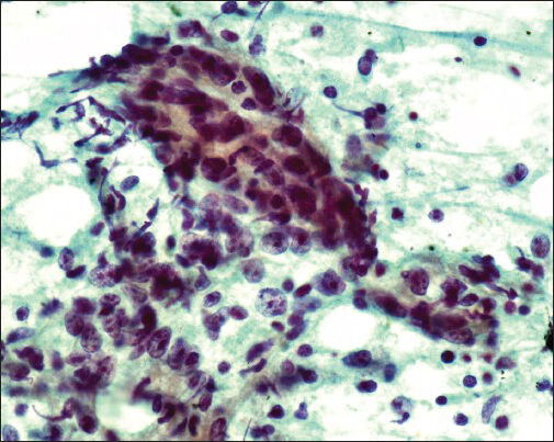 Cytology smear from mediastinal lymph node reveals metastatic nasopharyngeal carcinoma (Papanicolau stain, original magnification ×500)