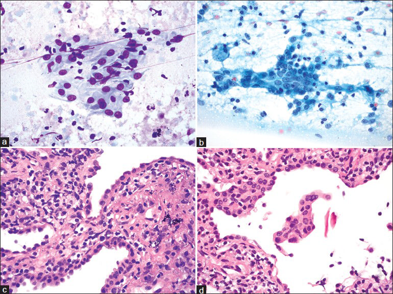 Type II pneumocytes. (a and b) Touch preparations show type II pneumocytes arranged in flat sheets (a and b). These epithelial cells have small but conspicuous nucleoli, bland chromatin and a moderate amount of rather dense cytoplasm. (c and d) Corresponding core biopsy showing type II pneumocyte hyperplasia. ((a) Diff Quik, ×600; (b) Papanicolaou, ×600; (c and d) H and E, ×600)