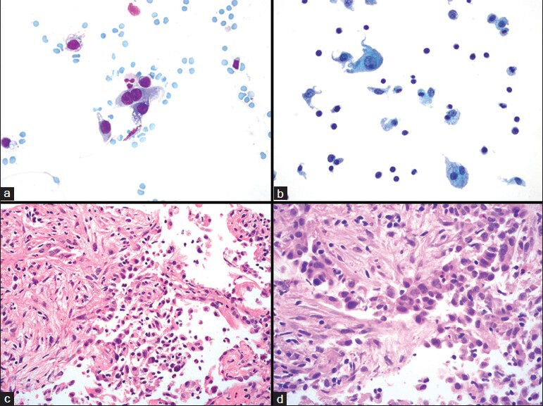 Type II pneumocytes and organizing pneumonia. (a and b) Fine needle aspiration showing type II pneumocytes arranged as single cells, including one that is binucleated (a). (b) Type II pneumocyte present in the left upper portion of the image; other cells include histiocytes, which have a lower nuclear-to-cytoplasmic ratio and small lymphocytes. (c and d) Histological sections of corresponding core biopsy show organizing pneumonia with associated type II pneumocyte hyperplasia. (a) Diff Quik, ×600; (b) Papanicolaou stain on ThinPrep, ×600; (c) H and E, ×400. (d) H and E, ×600)