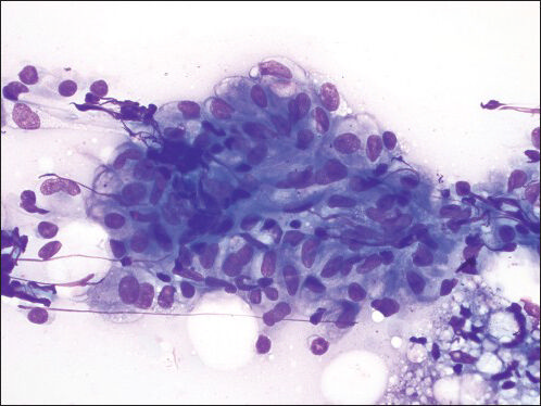 Granuloma fine needle aspiration direct smear shows a cluster of epithelioid histiocytes consistent with a granuloma (Diff Quik, ×600)