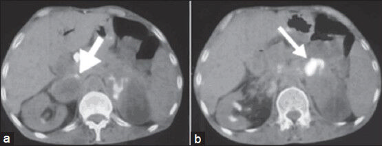 Axial fused positron emission tomography/computed tomography images show cystic necrotic adrenal masses with the peripheral fluorodeoxyglucose uptake (arrows) on the right (a) and on the left (b)