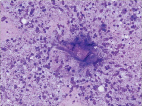 Fragments of laminated cyst wall with necrotic debris (smear, May-Grünwald-Giemsa, ×400)