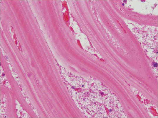 The laminated cyst wall presents typical appearance in cell block as parallel, acellular striations (cell block, H and E, ×1000)