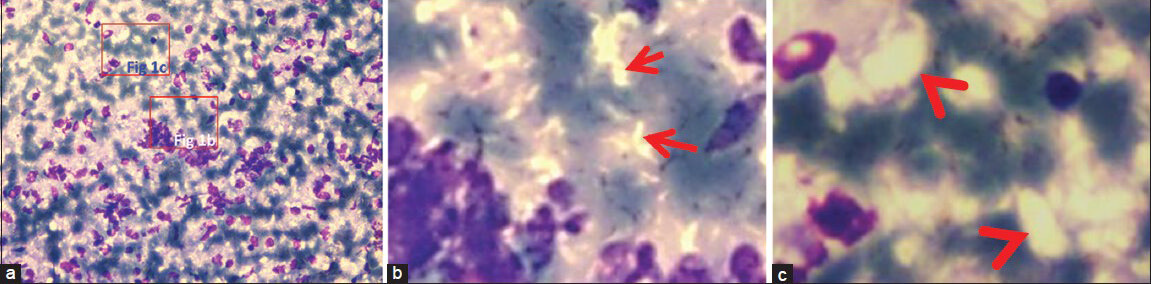 (a) Discrete spindle cells and foamy histiocytes with unstained acid-fast bacilli highlighted as negative staining (May Grunwald Geimsa stain, ×high power), (b and c) Negatively stained organisms as single or narrow bundles (arrows) and thicker bundles (arrow heads)