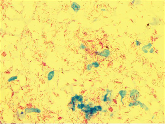 Abundant discrete and small bunches of acid fast lepra bacilli (Modified Ziehl–Neelson stain, ×Oil immersion)