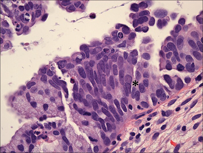 Histology of the stratified mucin-producing intraepithelial lesion. Note the cellular crowding, presence of small nucleoli and occasional binucleation (asterisk). (H and E, ×63)