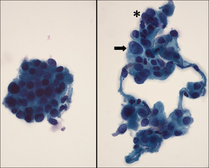 Epithelial fragments with marked cellular crowding (left image), hyperchromasia, nuclear size variation (right image: Arrow) and occasional binucleation (right image: Asterisk) are identifiable cytologic features in this case. (Papanicolaou, ×63)