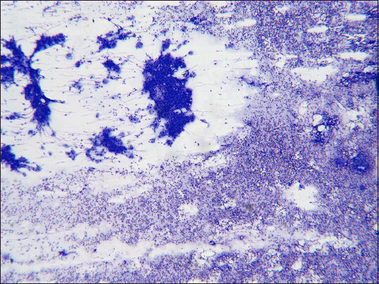 Epithelial clusters admixed with lymphocytes in the background (Diff Quik, ×4)