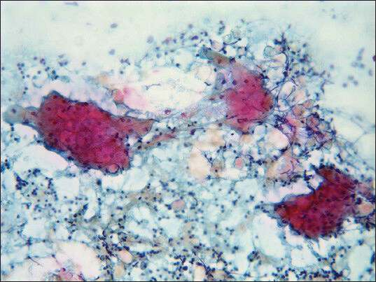 Epithelial cell clusters with abundant cytoplasm and small nuclei; numerous lymphocytes are present in the background (Pap, ×20)