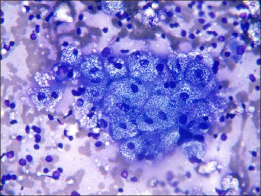 Microvesicular cytoplasm: Characteristic of sebocytes (Diff Quik, ×40)