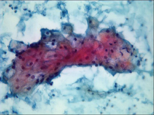 Microvesicular cytoplasm: Characteristic of sebocytes (Pap stain, ×40)