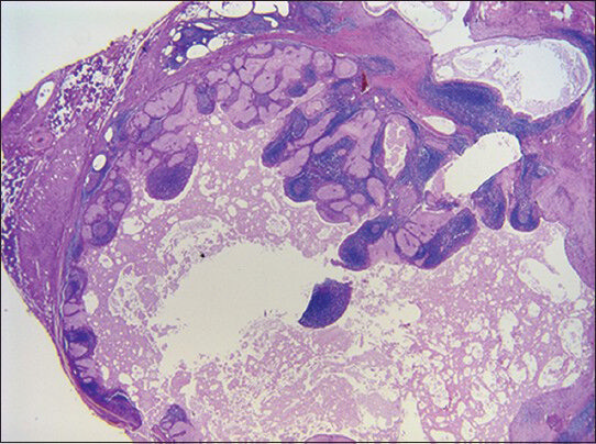 Sebaceous lymphadenoma (H and E, ×10)