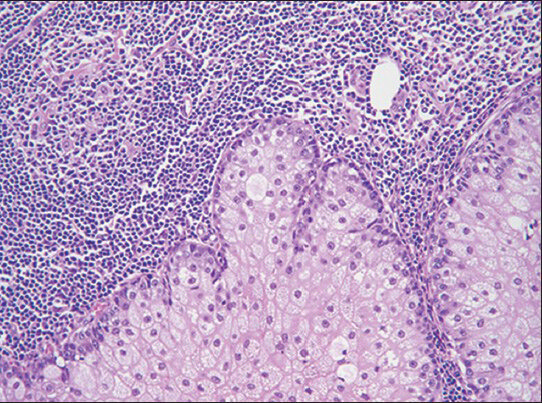 Sebaceous lymphadenoma (H and E; ×20)