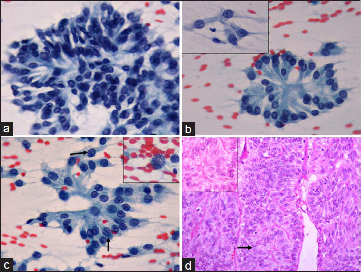 (a) A papillary cluster of tumor cells displaying prominent pseudostratification of nuclei toward the periphery (Papanicolaou, ×400). (b) Rosette-like clusters of tumor cells with tall cytoplasm merging toward the lumen. Inset shows singly lying cells with columnar configuration and wispy cytoplasm (Papanicolaou, ×400). (c) Prominent nuclear grooves (black arrows) were seen in the fine needle aspiration smears. Inset shows presence of mitotic figures (Papanicolaou, ×400). (d) Histologic section of tumor showing trabecular arrangement with presence of pseudostratification and rosette-like structures (black arrow). Inset highlights the same rosette-like structures (H and E, ×200)