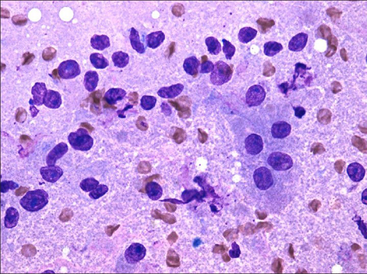 Diff-quik (×20) stains highlight intact cells with abundant granular cytoplasm and bare nuclei in a granular background