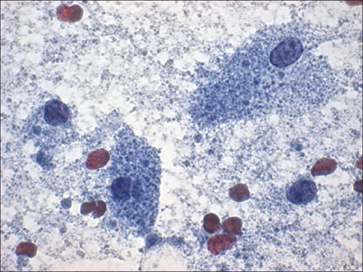 Papanicolaou stain (×40) shows few intact cells with abundant granular cytoplasm and bland nuclei